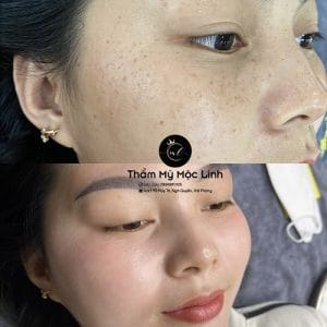 ĐIỀU TRỊ NÁM TÀN NHANG PHÁC ĐỒ CHUẨN Y KHOA