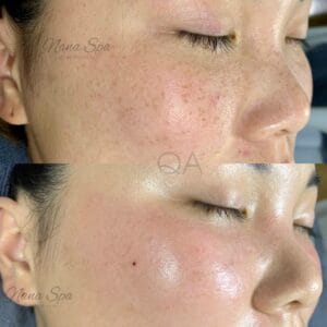 Điều trị tàn nhang
