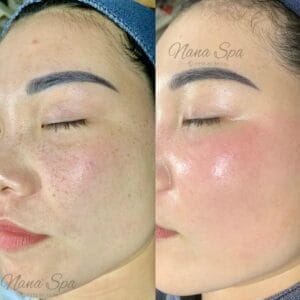 Điều trị tàn nhang