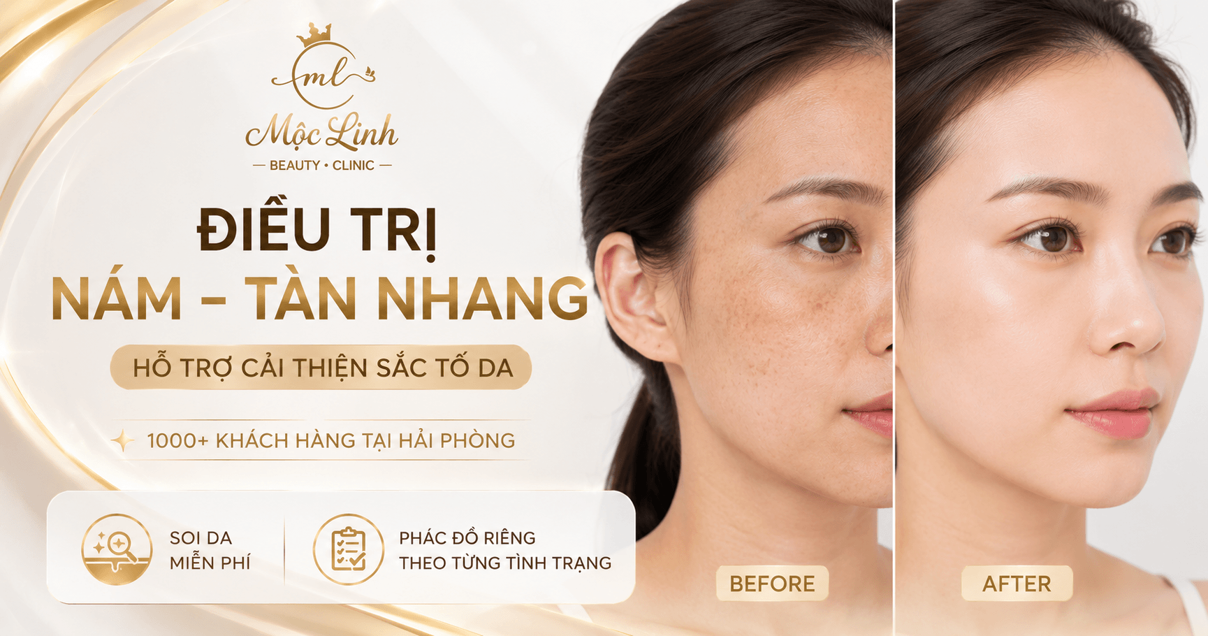 Điều Trị Nám