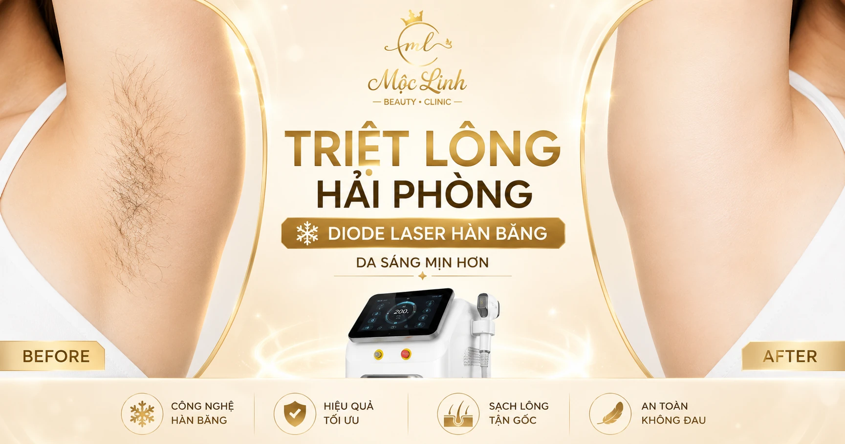 Triệt Lông