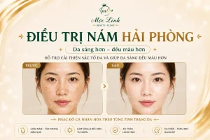 Trị nám/tàn nhang uy tín tại Hải Phòng