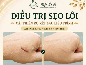 Điều trị các loại sẹo uy tín Hải Phòng