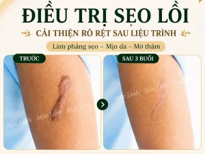 Điều trị các loại sẹo uy tín Hải Phòng
