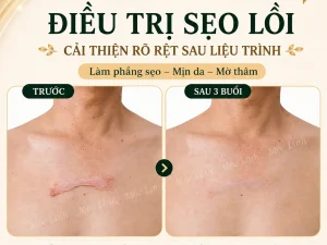 Điều trị các loại sẹo uy tín Hải Phòng
