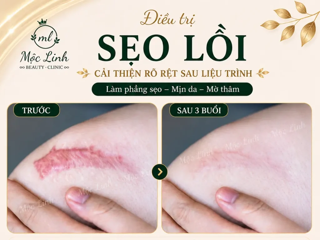 Điều trị các loại sẹo uy tín Hải Phòng