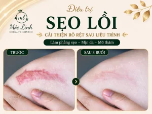 Điều trị các loại sẹo uy tín Hải Phòng