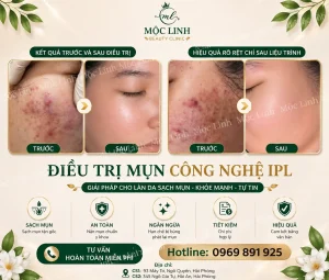 Trị Mụn Số 1 Hải Phòng
