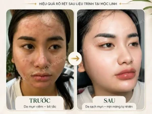 Trị Mụn Số 1 Hải Phòng