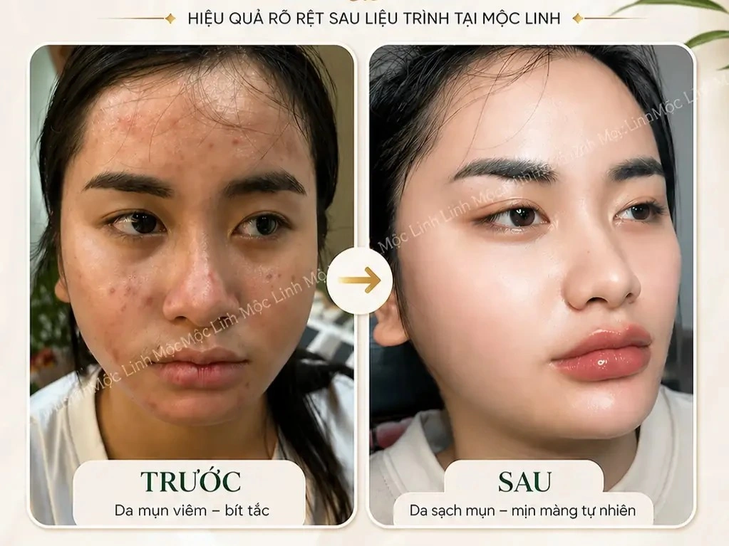 Trị Mụn Số 1 Hải Phòng