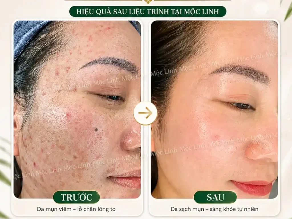 Trị Mụn Số 1 Hải Phòng