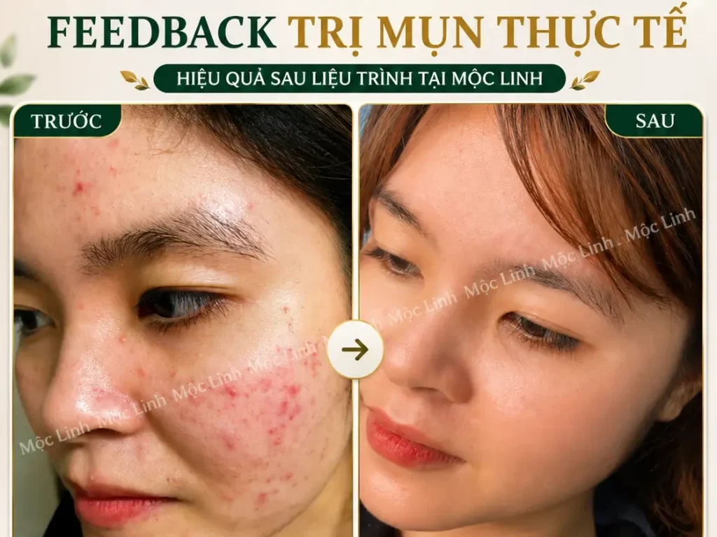 Trị Mụn Số 1 Hải Phòng