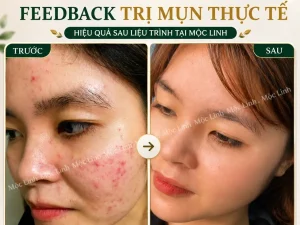 Trị Mụn Số 1 Hải Phòng