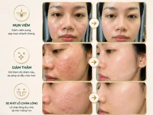 Trị Mụn Số 1 Hải Phòng