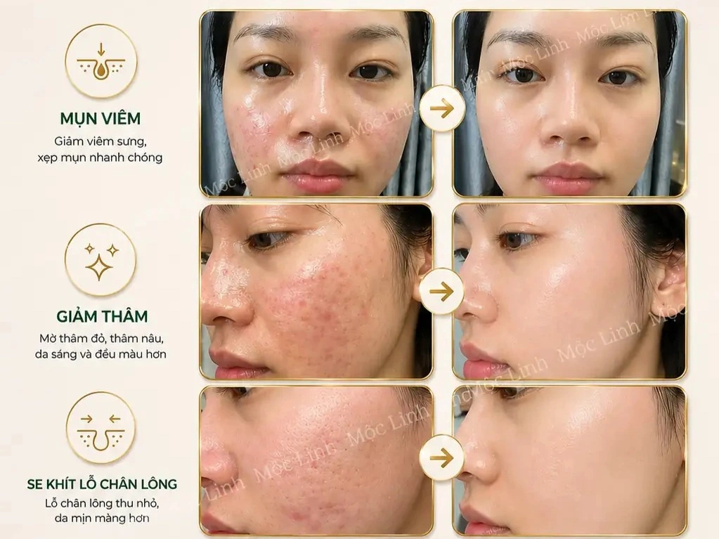 Trị Mụn Số 1 Hải Phòng