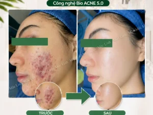 Trị Mụn Số 1 Hải Phòng