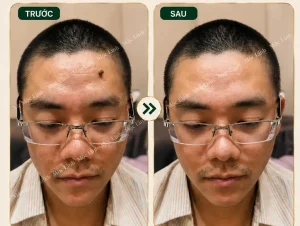Tẩy nốt ruồi, mụn cơm, mụn thịt
