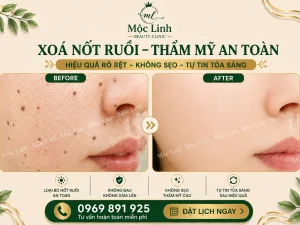 Tẩy nốt ruồi, mụn cơm, mụn thịt