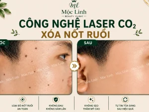 Tẩy nốt ruồi, mụn cơm, mụn thịt