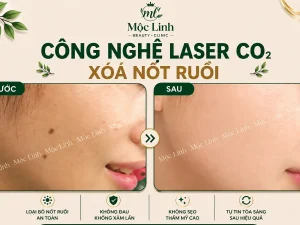 Tẩy nốt ruồi, mụn cơm, mụn thịt