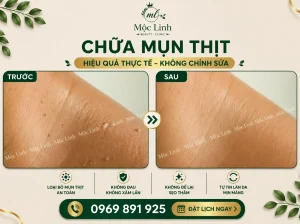 Tẩy nốt ruồi, mụn cơm, mụn thịt