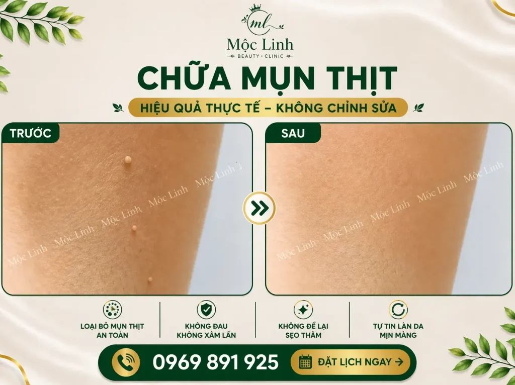 Tẩy nốt ruồi, mụn cơm, mụn thịt