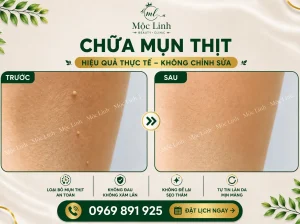 Tẩy nốt ruồi, mụn cơm, mụn thịt