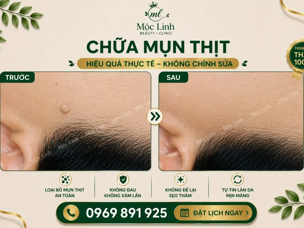 Tẩy nốt ruồi, mụn cơm, mụn thịt