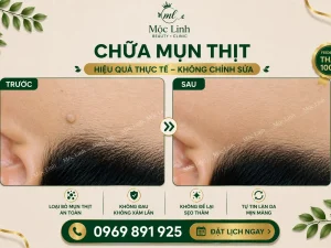 Tẩy nốt ruồi, mụn cơm, mụn thịt