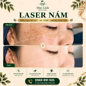 Trị nám/tàn nhang uy tín tại Hải Phòng
