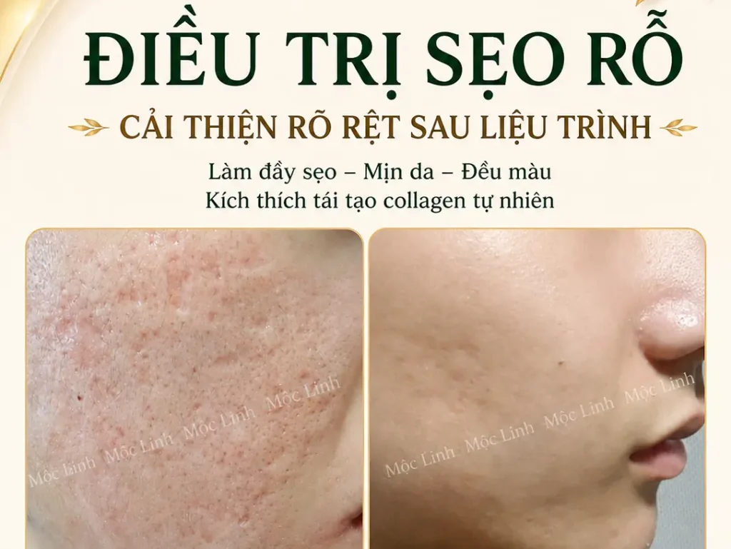 Điều trị các loại sẹo uy tín Hải Phòng