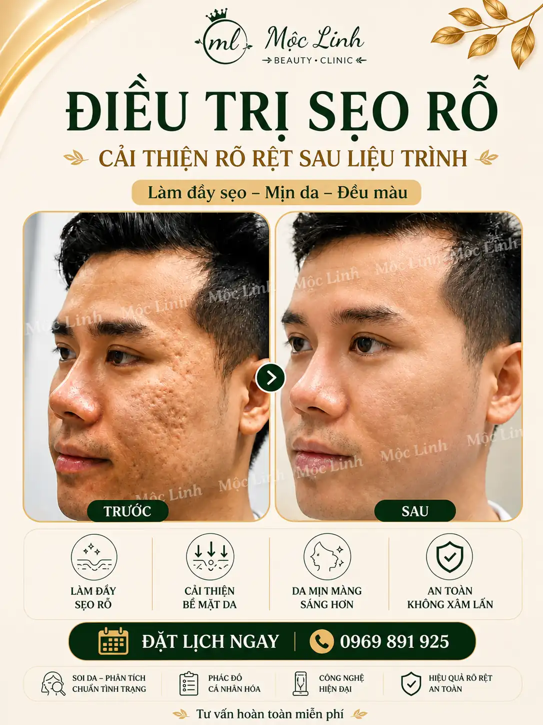 Hình ảnh khách hàng điều trị sẹo rỗ tại Hải Phòng