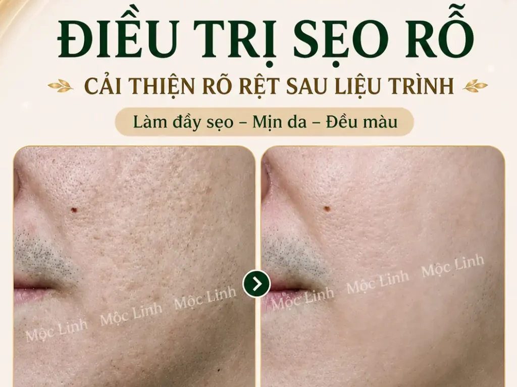 Điều trị các loại sẹo uy tín Hải Phòng