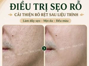 Điều trị các loại sẹo uy tín Hải Phòng