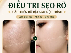 Điều trị các loại sẹo uy tín Hải Phòng