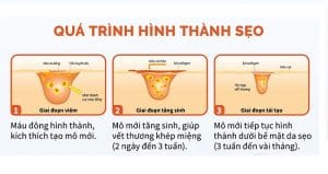 Sự hình thành của sẹo 