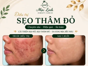 Điều trị các loại sẹo uy tín Hải Phòng