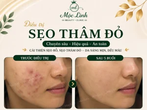 Điều trị các loại sẹo uy tín Hải Phòng