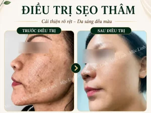 Điều trị các loại sẹo uy tín Hải Phòng