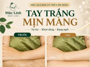 Triệt Lông Hải Phòng