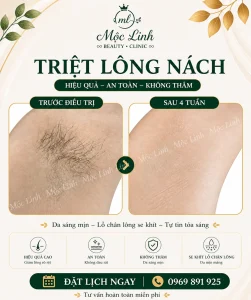 Triệt Lông Hải Phòng