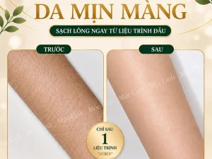 Triệt Lông Hải Phòng