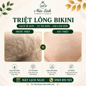 Triệt Lông Hải Phòng