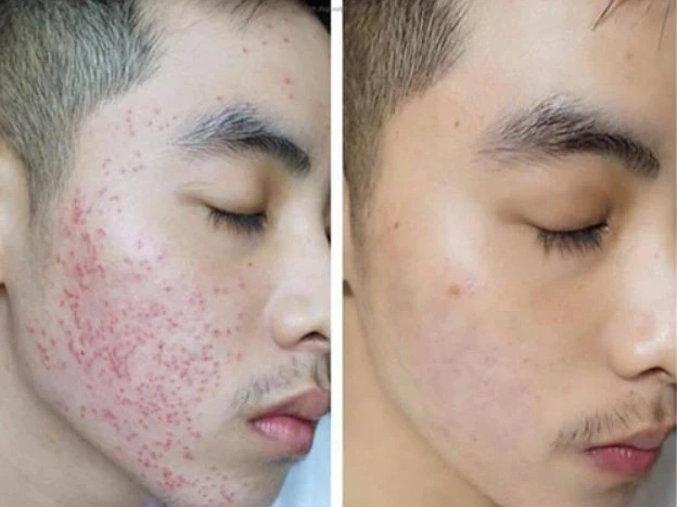 Trị Mụn Số 1 Hải Phòng