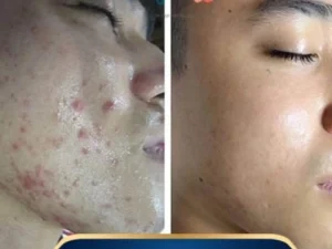 Trị Mụn Số 1 Hải Phòng