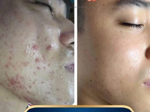 Trị Mụn Số 1 Hải Phòng