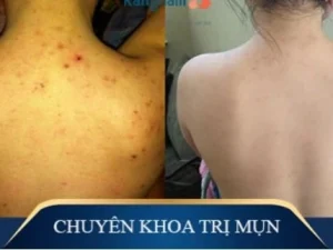 Trị Mụn Số 1 Hải Phòng