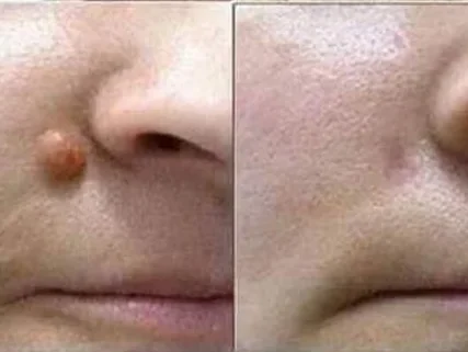 Tẩy nốt ruồi, mụn cơm, mụn thịt
