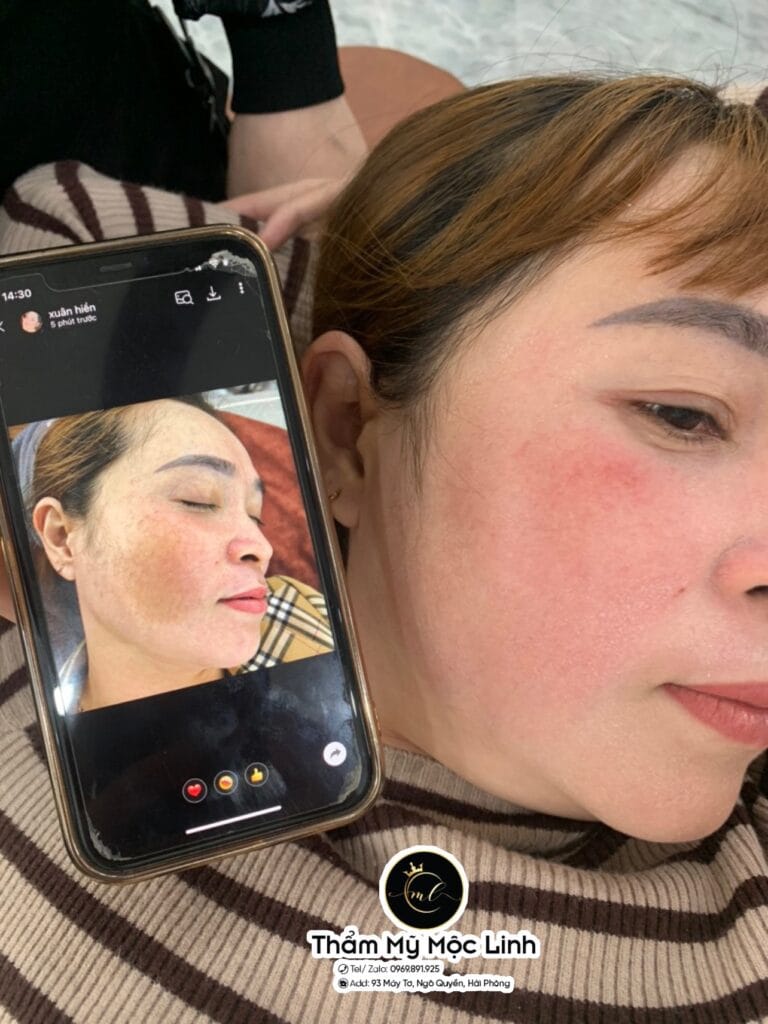 Điều trị tàn nhang