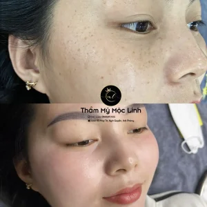 Trị nám/tàn nhang uy tín tại Hải Phòng